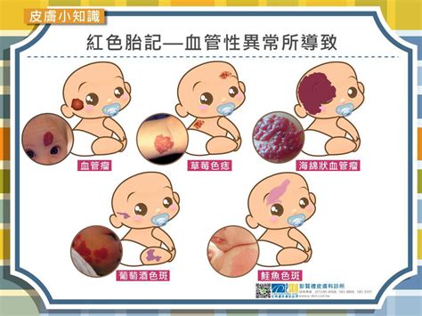 痣胎記|認識胎記的種類與治療照顧